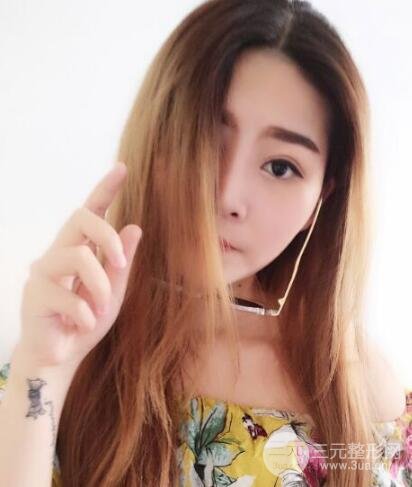 全切开双眼皮价格和恢复过程对比图片