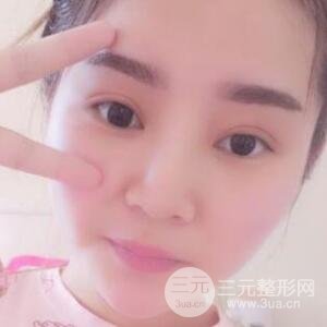 全切开双眼皮价格和恢复过程对比图片
