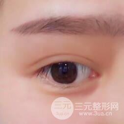 全切开双眼皮价格和恢复过程对比图片