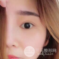 全切开双眼皮价格和恢复过程对比图片