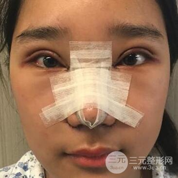 切开双眼皮+开眼角+隆鼻多项整形手术价格和恢复过程图案例