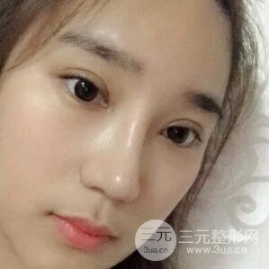 切开双眼皮+开眼角+隆鼻多项整形手术价格和恢复过程图案例