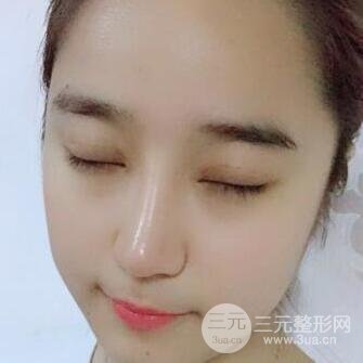 切开双眼皮+开眼角+隆鼻多项整形手术价格和恢复过程图案例