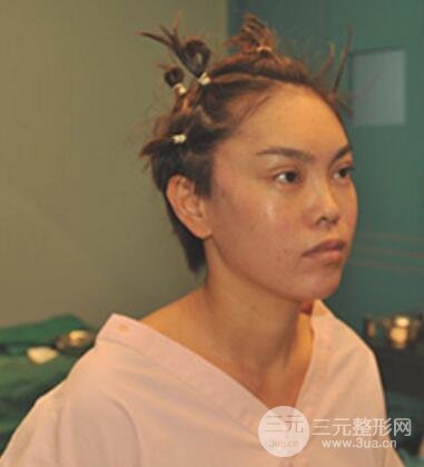 去做了埋线面b提拉术果很是不错