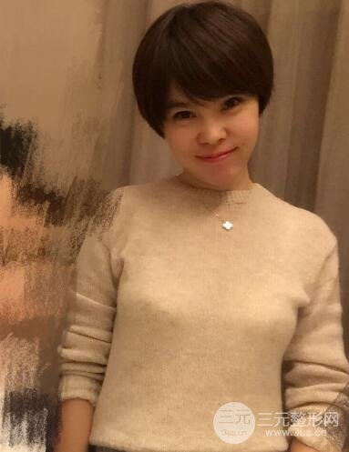 去做了埋线面b提拉术果很是不错