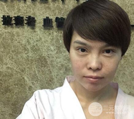 去做了埋线面b提拉术果很是不错