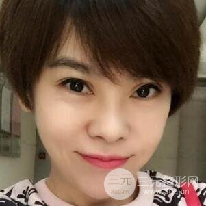 去做了埋线面b提拉术果很是不错