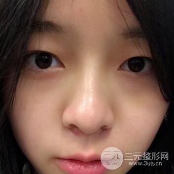 割双眼皮手术价格和1-7恢复图片案例