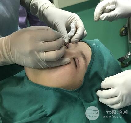 割双眼皮手术价格和1-7恢复图片案例