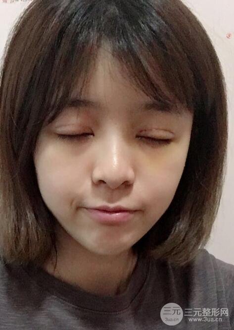 割双眼皮手术价格和1-7恢复图片案例
