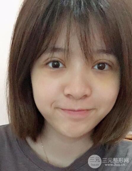 割双眼皮手术价格和1-7恢复图片案例