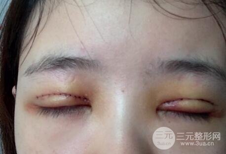 割双眼皮手术价格和1-7恢复图片案例