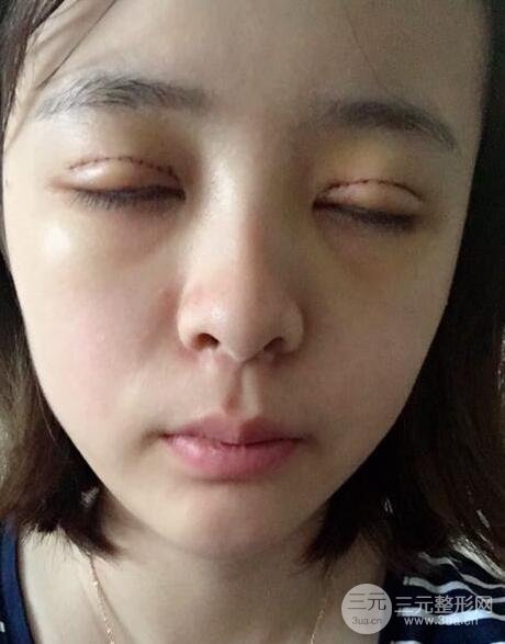 割双眼皮手术价格和1-7恢复图片案例