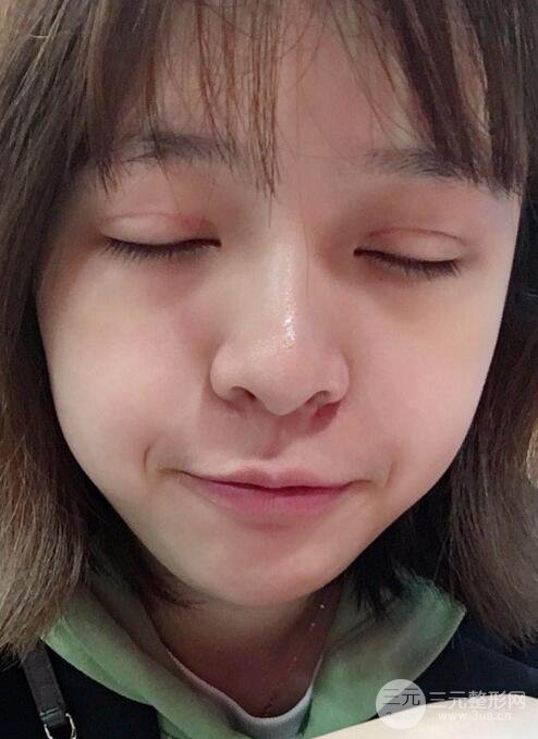 割双眼皮手术价格和1-7恢复图片案例