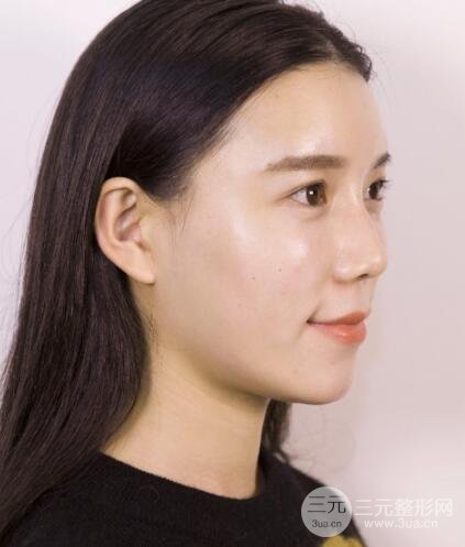 终于去做了全脸自体脂肪填充，果还是很不错的