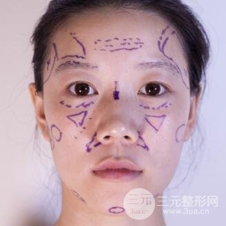 终于去做了全脸自体脂肪填充，果还是很不错的