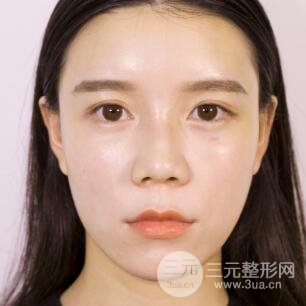 终于去做了全脸自体脂肪填充，果还是很不错的