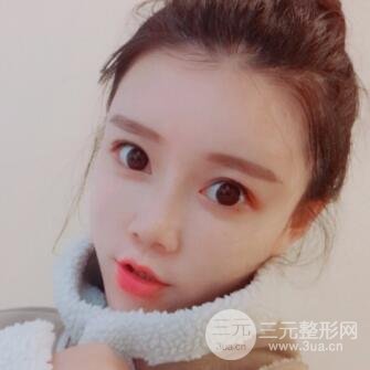 终于去做了全脸自体脂肪填充，果还是很不错的
