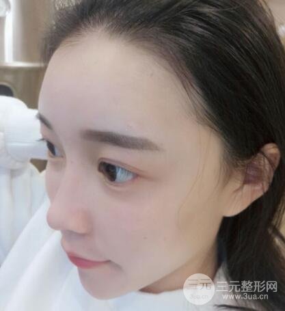 终于去做了全脸自体脂肪填充，果还是很不错的