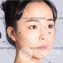 面部自体脂肪填充+隆鼻整形+双眼皮案例，恢复果照片~