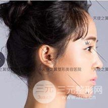 面部自体脂肪填充+隆鼻整形+双眼皮案例，恢复果照片~
