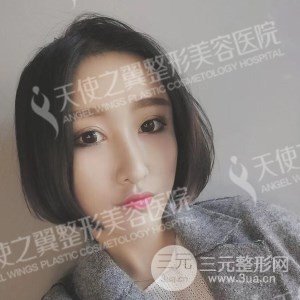 芭比双眼皮+去眼袋案例分享，还有恢复过程照片哦~