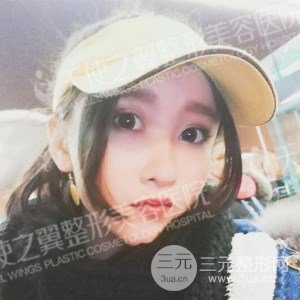 芭比双眼皮+去眼袋案例分享，还有恢复过程照片哦~