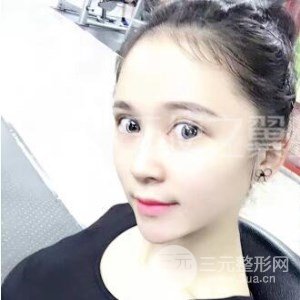 芭比美眼+假体隆胸真是案例果图片分享~