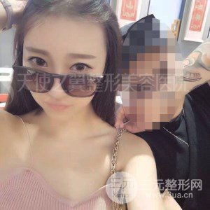 自体脂肪面部填充+全鼻金雕真实案例，恢复照片分享~