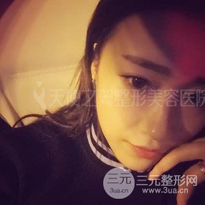 自体脂肪面部填充+全鼻金雕真实案例，恢复照片分享~