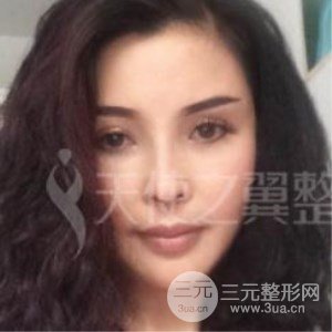 隆鼻整形修复+自体脂肪详细部填充案例分享~