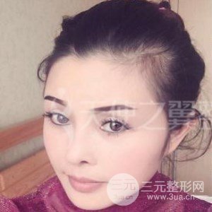 隆鼻整形修复+自体脂肪详细部填充案例分享~