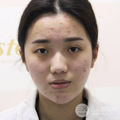 切开双眼皮15天果图分享