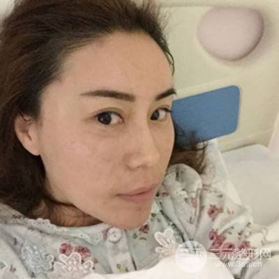 武汉美仑陈远海自体脂肪填充全脸案例，附上前后对比图片