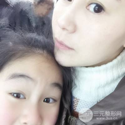 武汉美仑陈远海自体脂肪填充全脸案例，附上前后对比图片