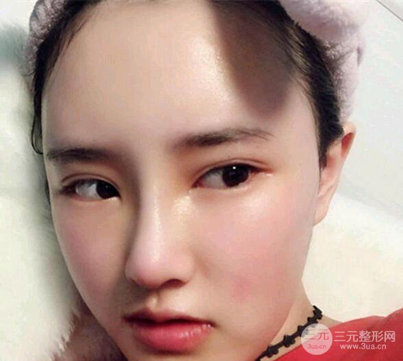 南京美范整形沈干“自体脂肪填充+隆鼻整形”真人记录分享