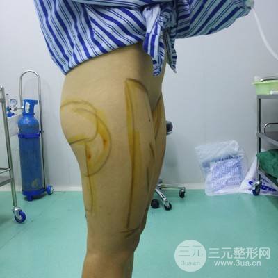 武汉美仑陈远海医生做的大腿吸脂案例，分享一下前后对比图