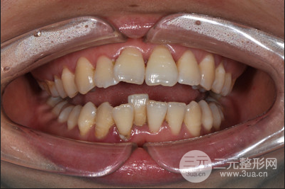 昆明医科大学附属口腔医院黎明牙齿矫正果分享