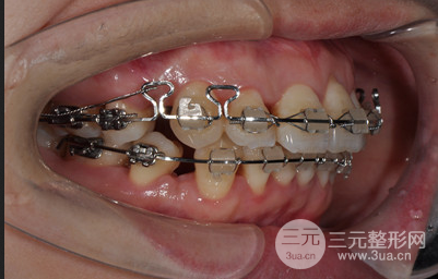 昆明医科大学附属口腔医院黎明牙齿矫正果分享