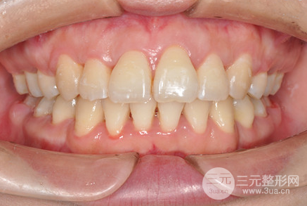 昆明医科大学附属口腔医院黎明牙齿矫正果分享