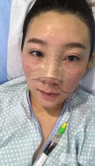 隆鼻整形前后恢复图对比   小仙女进化论