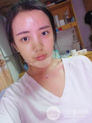 自体脂肪填充额头+丰下巴真实案例，昆明都市俪人金海坤医生做的