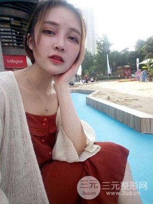 切开双眼皮+假体隆鼻案例，前后对比图分享