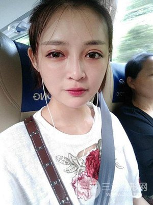 切开双眼皮+假体隆鼻案例，前后对比图分享