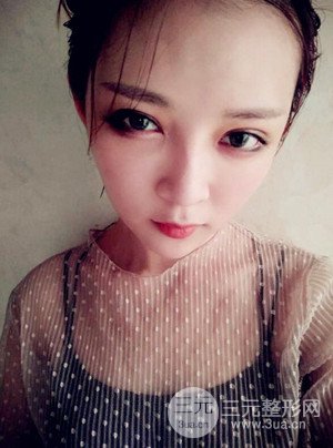 切开双眼皮+假体隆鼻案例，前后对比图分享