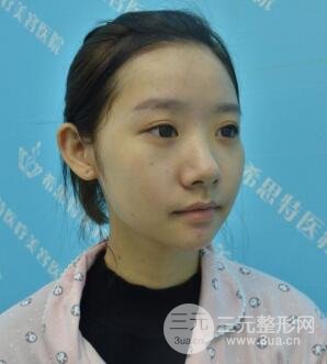 武汉希思特杨权明假体隆鼻案例日记真实记录分享