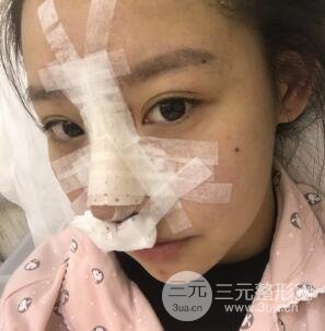 武汉希思特杨权明假体隆鼻案例日记真实记录分享