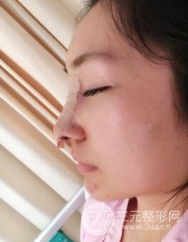 上海百*丽别筝隆鼻隆鼻整形案例果图片日记分享