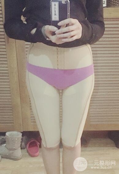 大腿抽脂后的恢复过程，真人案例真实分享