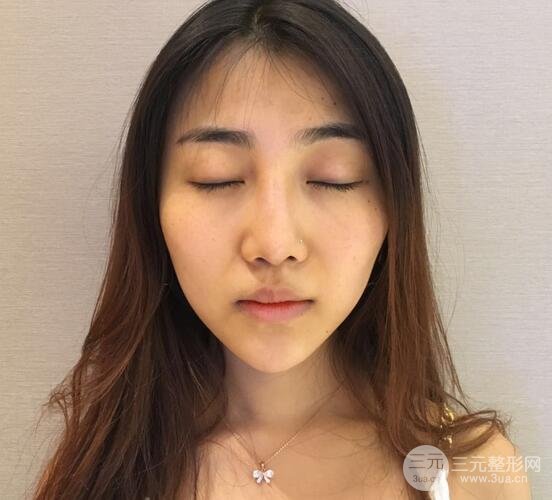 隆鼻整形术后1-7天的照片，前后对比果图分享